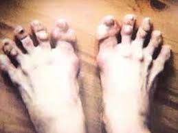Why Do Basketball Players Like Lebron James And Shaquille O Neal Have Such Gross Feet Quora