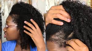 Please click on your scenario below to see the regrowthclub solution best suited. Natural Hair Talk Traction Alopecia Regrowth Thinning Edges And Bald Traction Alopecia Natural Hair Styles Help Hair Loss