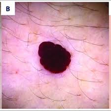 Normally they are multiplex spots and focus predominantly on the upper trunk and arms. Pdf Halo Formation Around Cherry Angiomas A Rare But Substantial Finding
