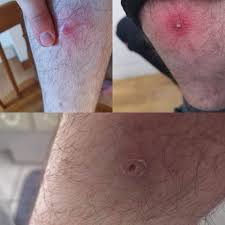 If there is ingrown hair on your skin, the best thing to do is leave it alone. From Ingrown Hair To Hole In My Leg This Really Really Hurt I Ve Been Left With A Scar On My Leg And A Massive Bald Patch Wellthatsucks