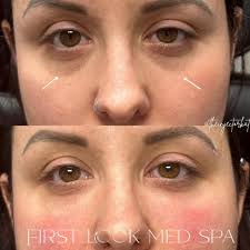 Stunning results with Restylane Eyelight! Brighten up those Tired Eyes 💤