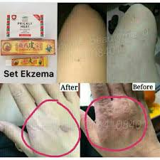 Kulit gatal bisa disebabkan oleh banyak hal seperti reaksi alergi, gigitan serangga, atau kondisi kulit seperti eksim dan psoriasis. Ubat Gatal Kulit Prices And Promotions May 2021 Shopee Malaysia
