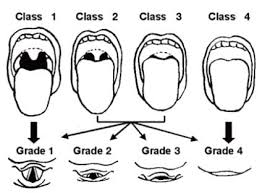 I use the image in figure 1, below, to show patients what i am seeing when i look at the back of their throats. Mallampati Score Litfl Medical Eponym Library