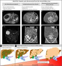 Polycystic Liver Disease An Overview Of Pathogenesis Clinical Manifestations And Management Orphanet Journal Of Rare Diseases Full Text