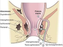 Kondisi ini disebabkan oleh adanya infeksi yang berkembang menjadi benjolan berisi nanah (abses) di area kulit sekitar anus. Perianal Fistula And Abscess Prof Dr Gokhan Cipe