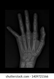 Image result for Hand Growth Plates