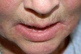 Image result for oral thrush symptoms roof of the mouth