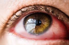 Image result for Vernal Conjunctivitis