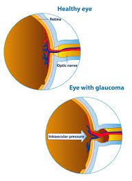 Glaucoma Test · Top Eye Doctors, Specialists In Nyc · Optometrist &  Ophthalmologist