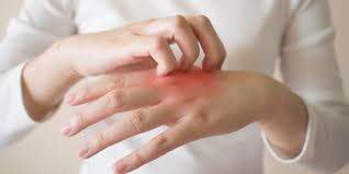 Umumnya, gejala mata kering dapat dikendalikan pasca pengobatan. Beragam Gejala Psoriasis Penyakit Kronis Yang Bikin Kulit Bersisik Halaman All Kompas Com