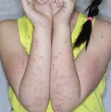 Image result for Photodermatitis