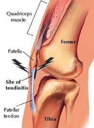 It causes pain and tenderness below the knee and limits activities. Patellar Tendonitis Patella Tendonitis Patellar Tendon Pain