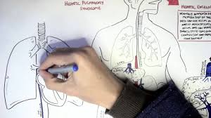When the liver cells are damaged they are replaced with scar tissue (fibrosis) and nodules of scar tissue form within the liver. Liver Cirrhosis Youtube