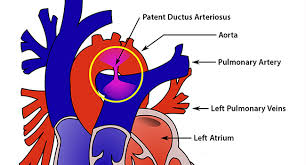In pda, abnormal blood flow occurs between two of the major arteries connected to the heart. Patent Ductus Arteriosus Pda Symptoms Treatment