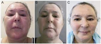 Chronic erythematous edema of the face; Morbihan Syndrome Successfully Treated With Omalizumab Html Acta Dermato Venereologica