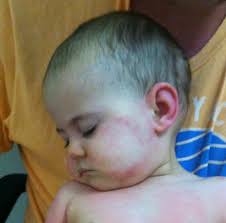 Why do so many people have allergies? I Have A Child With A Severe Food Allergy Laughing Kids Learn
