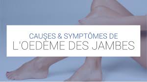 Des symptômes d'un oedème pulmonaire. Oedeme Des Jambes Comment Combattre La Retention D Eau