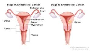 It may also have a tool. Womb Cancer Symptoms What It S Like To Have Uterine Or Endometrial Cancer As A Young Woman By New Youtube