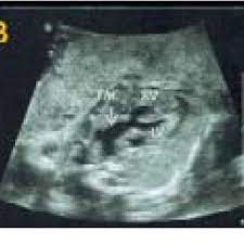Pdf Truncus Arteriosus Communis Report Of Three Cases And Review Of Literature