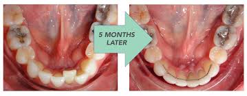 Alibaba.com offers 71,166 retainer products. Retainers For Life