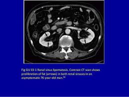 Renal Sinus Lipomatosis Sinusitis Renal Ct Scan