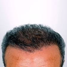 Sei di torino e sei vuoi la correzione della calvizie con il trapianto capelli esclusivo micro fue? Milano Capitale Italiana Dell Auto Trapianto Dei Capelli