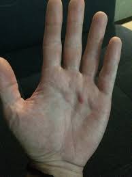 Weird Bump In Palm