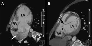 Image result for Endocardial Cushion Defect