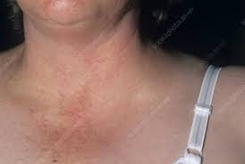 Sometimes, cancers that are more distant, like colon cancer or urogenital cancers, can cause metastasis to the supraclavicular lymph nodes. Swollen Lymph Node Stock Image M131 0633 Science Photo Library
