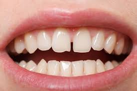 Maybe you would like to learn more about one of these? How To Close Space Between Front Teeth Angel Orthodontics