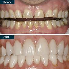 If you compare porcelain veneers with composite resin, the former is a more expensive option than the latter. Dental Veneers Procedure In The Bronx Ny Press On Veneers Teeth