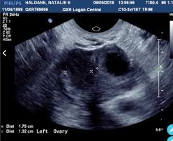 Image result for corpus luteum sonography)
