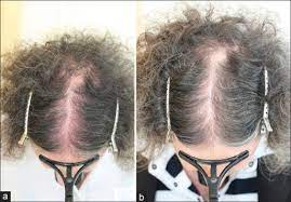 Contact dermatitis happens when your skin reacts badly to something that touches it. A And B Red Scalp Syndrome Before And After 6 Months Open I