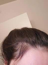 My Hair Is Growing Back Finally!! 8 Months Pp. Now If Only My Baby Would  Stop Pulling The New Hairs Out : R/Beyondthebump