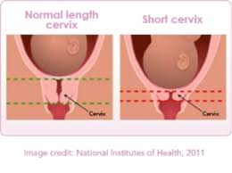 Sit on the toilet, or stand with one foot on a high stool so the knee is flexed about 90 degrees, to work around your. Cervical Insufficiency And Short Cervix