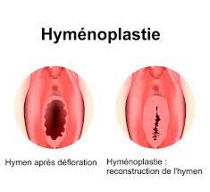 Hymenoplastie Comment Reconstruire L Hymen
