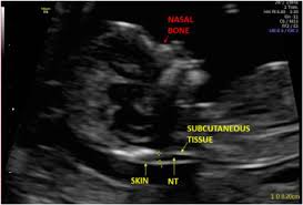 Nuchal translucency (nt) is a collection of fluid under the skin at the back of your baby's neck. Nuchal Translucency Measurement An Overview Sciencedirect Topics