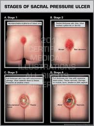 Stages Of Sacral Pressure Ulcer Nurse Pressure Ulcer Wound Care Nursing