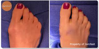Suddenly, your shoes don't quite fit as well as they used to how to prevent it: Before After Bunion Surgery Photo Gallery Los Angeles Foot Doctor Beverly Hills