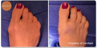 Suddenly, your shoes don't quite fit as well as they used to how to prevent it: Before After Bunion Surgery Photo Gallery Los Angeles Foot Doctor Beverly Hills