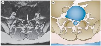 Image result for Low Back Imaging