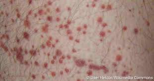 What is sepsis (blood infection), its symptoms and the early signs of it? Purpura Schonlein Henoch Symptome Verlauf Behandlung Netdoktor