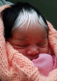 Based on the presence of a white forelock, patches of depigmented skin, and sensorineural hearing loss, the infant was diagnosed as having waardenburg syndrome. Little Girl Born With A White Patch Of Hair Which Is Exactly The Same As Her Mum S Bored Panda