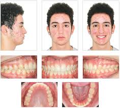 This facilitates eruption and orthodontic traction. Scielo Brasil Orthodontic Traction Of Impacted Canines Concepts And Clinical Application Orthodontic Traction Of Impacted Canines Concepts And Clinical Application