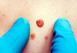 Learn about the academy's efforts to refocus its brand on education. Skin Tags Vs Moles Removal Of Benign Skin Imperfections