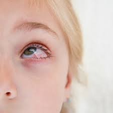 Image result for Eye Pain