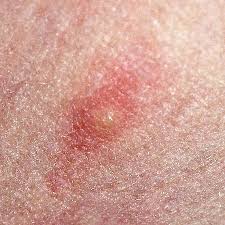 Additionally, a cold compress can help with swelling and skin irritation, and you need to avoid taking. Chigger Rerun Family Trombiculidae Field Station