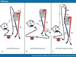 Extracorporeal Membrane Oxygenation In Adults Critical Care Nurse Cardiac