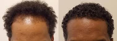 Diep is one of a very few hair surgeons. African American Hair Transplant In Miami Care4hair
