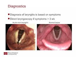 Image result for Acute Laryngitis